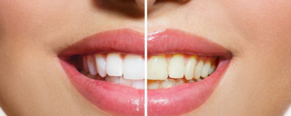 Αποκτήσετε τα πιο Λευκά Δόντια σε Ένα Μήνα με Αυτή τη Φυσική Συνταγή