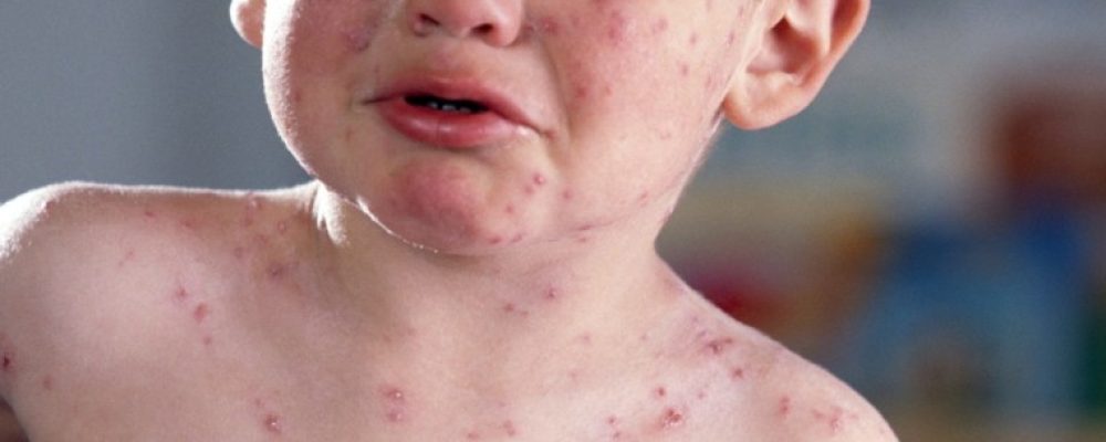 Φαρμακευτική αλλεργία: Πάρτε τα μέτρα σας