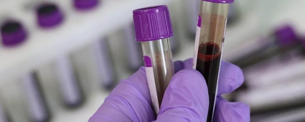 Η ομάδα αίματος  που συνδέεται με τον κίνδυνο πρόωρου εγκεφαλικού – Τι έδειξε νέα έρευνα