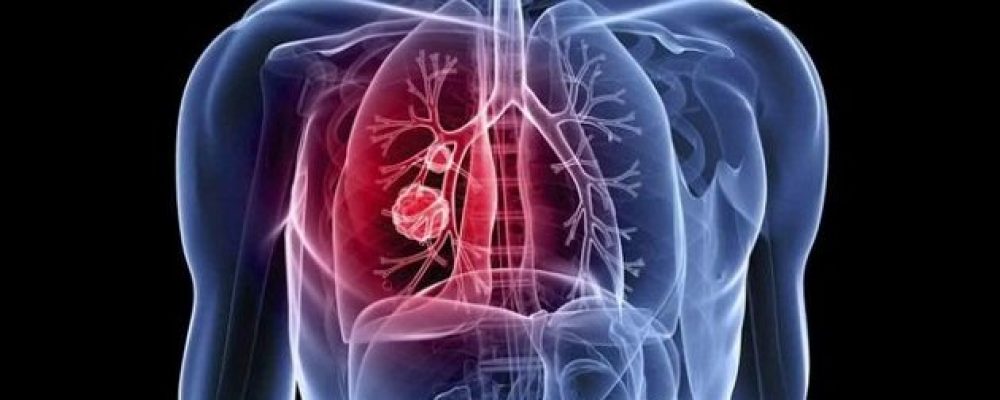 Tι ανακάλυψαν Βρετανοί επιστήμονες για τον καρκίνο του πνεύμονα