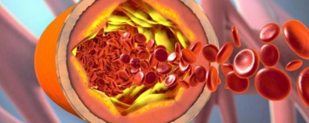 Χοληστερόλη: Οκτώ τρόποι να τη μειώσετε φυσικά